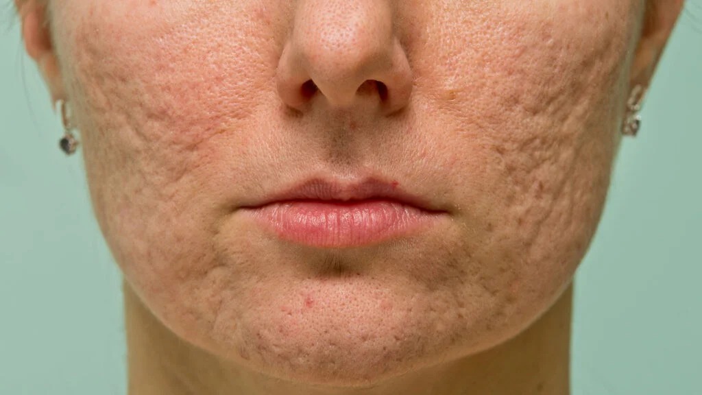 Causas hormonales y bacterianas